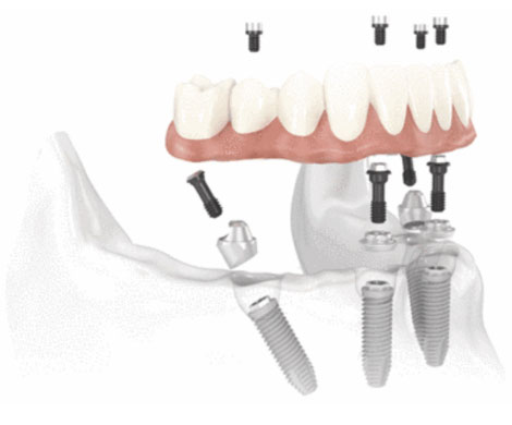 Anschauung Implantat